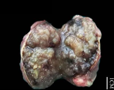 Papillary renal neoplasm with reverse polarity: A clinicopathological and molecular genetic characterization of 16 cases with expanding the morphologic spectrum and further support for a novel entity